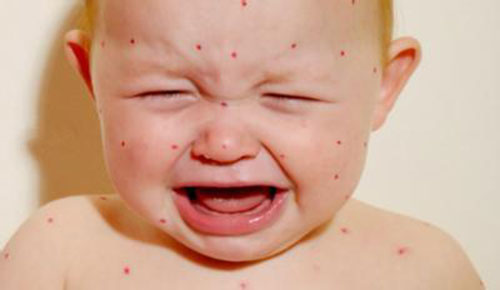 �ɺ��ȴ�Ⱦ�� �ɺ���֢״����Щ